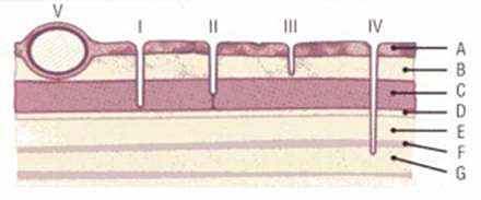 Dermoid figure 2a