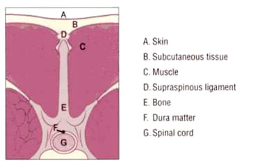 Dermoid figure 2b
