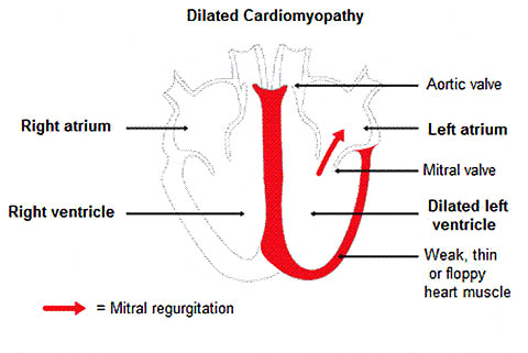 Dilated Cardiomyopathy figure 2