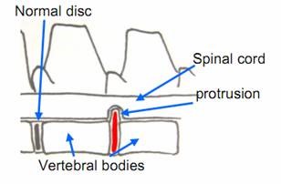 Intervertebral Disc Disease figure 3a